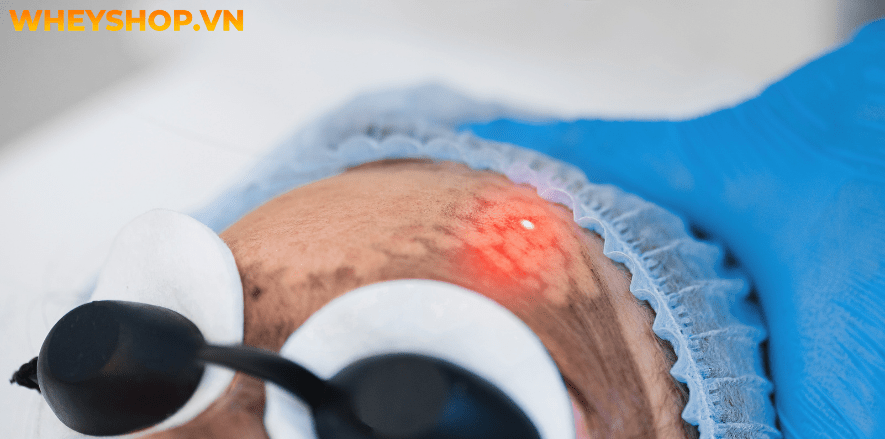 Điều trị các vấn đề về da bằng tia laser là liệu trình làm đẹp được nhiều phụ nữ áp dụng hiện nay. Vậy cách chăm sóc da sau khi bắn laser là như thế nào để...