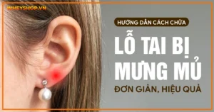 Hướng dẫn cách chữa bấm lỗ tai bị mưng mủ đơn giản, hiệu quả